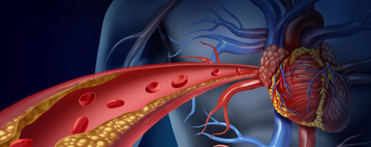 Kolesteroli i lartë: Simptomat, shkaqet dhe trajtimi